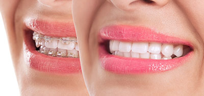 Orthodontics in Pleasant Grove