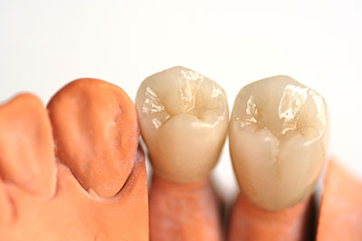 Dental Crowns in Pleasant Grove