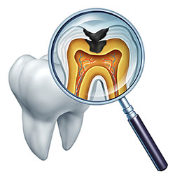 Pleasant Grove Tooth Decay Treatment