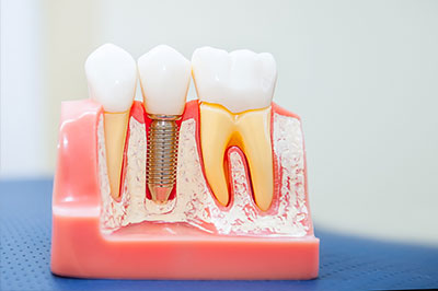 Dental Implants in Pleasant Grove
