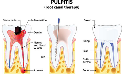 Root Canal Treatment in Pleasant Grove